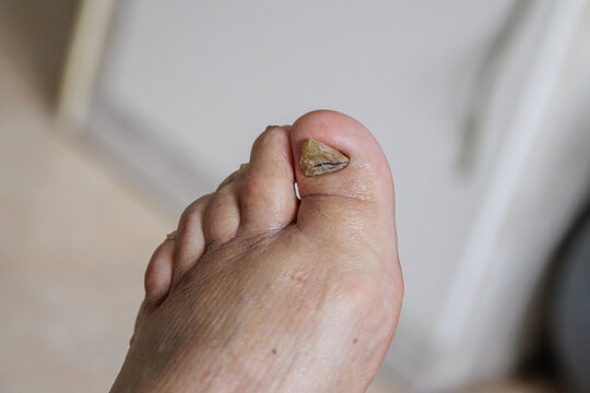 Toenail fungus. Birth problem in toenails