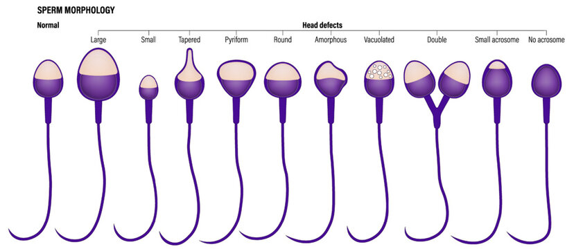 Normal and head defects spermatozoon. Semen analysis vector. Sperm morphology. Male reproductive system.