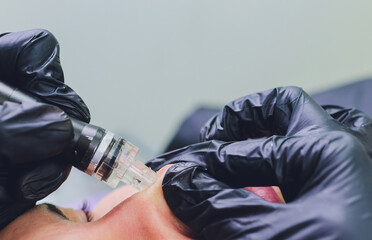 Woman cleaning nose skin pores using vacuum blackhead remover, cosmetic procedure.
