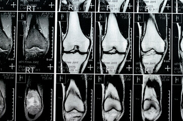 MRI of the right knee showing mild joint effusion, with normal other findings of PHMM, ACL, MCL,...