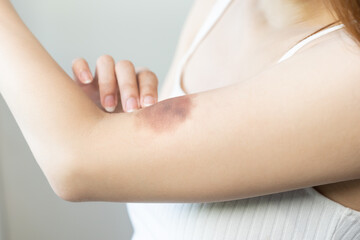 Fototapeta na wymiar Close up of stain bruise wound on her arm, contusion asian young woman, girl an accident fell down stairs at home, hand in healing injury by massage hematoma blood. Extravasation blue, purple on skin.