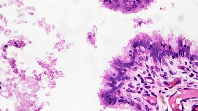 Bright field light micrograph of the cervix section was filmed at 200 times magnification. Investigation focused on human female tissue samples and aimed to analyze pathology of cervical cancer in lab