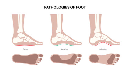 Foot pathologies poster - 640406850