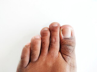 left toes of a caucasian man with dry skin and untidy nails isolated on white background