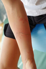 クラゲに刺された腕の傷跡