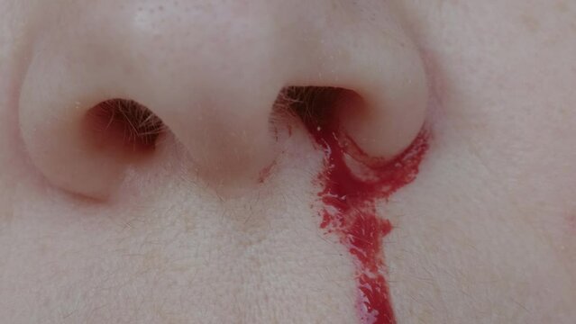 bright red blood flows from nostril, bright red blood flows from nostril, stop bleeding, epistaxis, close-up part of face, fragility of blood vessels, sharp increase in blood pressure