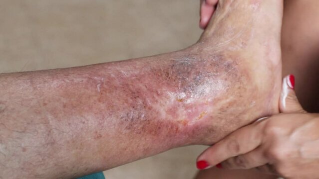Home health care for an elderly person. Leg with ulcer due to diabetes. Leg massage. At home.