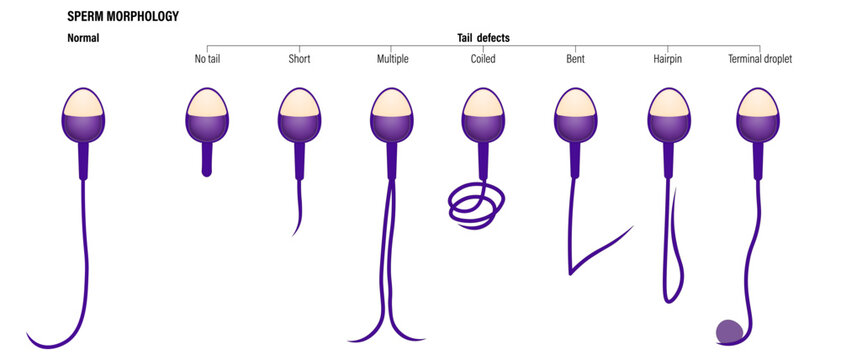 Normal and Tail defects spermatozoon. Semen analysis vector. Sperm morphology. Male reproductive system.