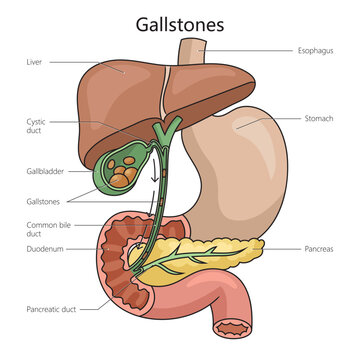 Gallstone stone formed within gallbladder from precipitated bile structure diagram schematic vector illustration. Medical science educational illustration
