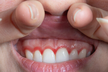 Close-up of a woman's red gums. Oral hygiene concept
