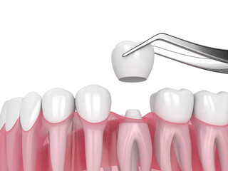 3d render of crown replacement on reshaped tooth