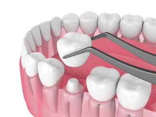 3d render of crown replacement on reshaped tooth