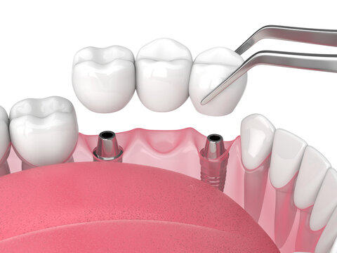 Jaw with implants supporting dental bridge over white