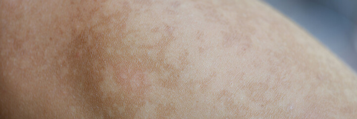 Macro part of the body is uneven pigmentation skin
