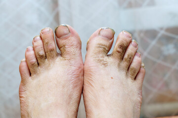 Fototapeta premium A view of dirty unkempt feet and dirty nails without a pedicure