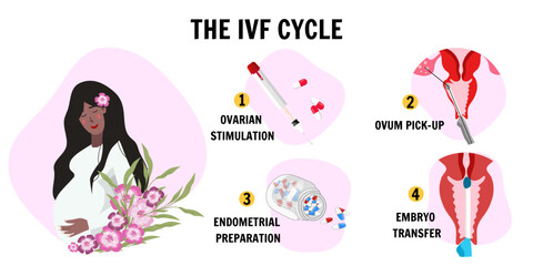 In vitro fertilization IVF infographics and illustrations with steps 