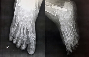 Plain x ray of the right foot of an old female patient with a new fissure fracture of the base of...