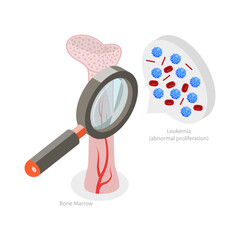 3D Isometric Flat  Conceptual Illustration of Leukemia Disease, Bone Marrow Anatomy - obrazy, fototapety, plakaty