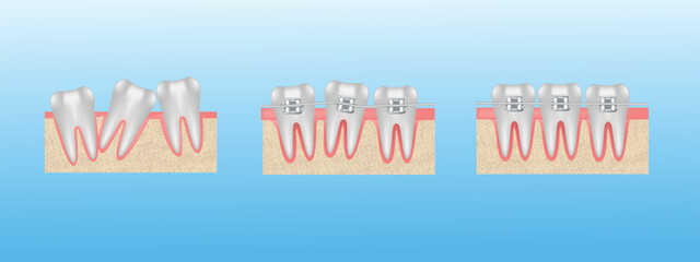 Teeth alignment , braces, medical illustration realistic vector