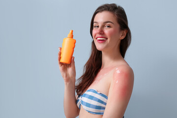 Allergic young woman with sunburned skin and cream on blue background