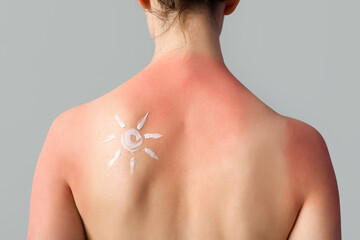 Allergic young woman with sunburned skin and sun made of cream on grey background, back view