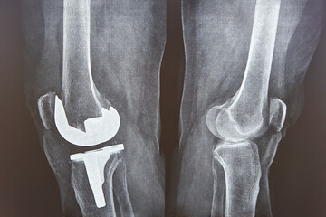 Knee cap replacement xrays. Titanium implant. Osteoarthritis. Anatomy