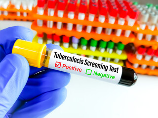 Blood sample for tuberculosis screening test