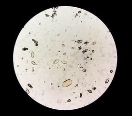 Photomicrograph of Uric acid crystal in urine sediment