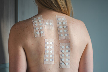 Patch test on the naked shoulder and back of a young blonde hair girl. Allergy patch testing is used to screen substances to determine the cause of an allergic skin reaction