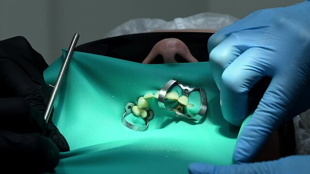Dental Extreme Close up Macro Video. Dentist treat patient teeth. Orthodontist works with an assistant use cofferdam. Concept of professional dental hygiene. 4k 120 fps slow motion raw footage