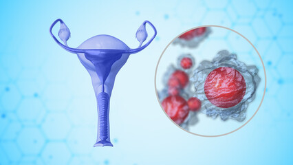The female reproductive system's infected ovaries 