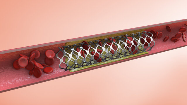 Insertion of a coronary angioplasty stent
