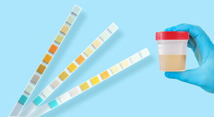 Hand holding urine sample container for medical urinalysis with color strip.