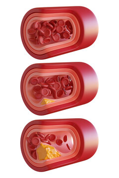 3D Rendering Artery Atherosclerosis Cut Three Step transparent