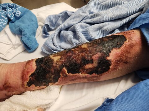 Superficial leg skin necrosis with ulcerations - gangrenous tissues