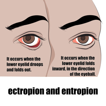 Entropion is a condition in which the eyelid folds inwards, ectropion is the eyelid folds outwards.