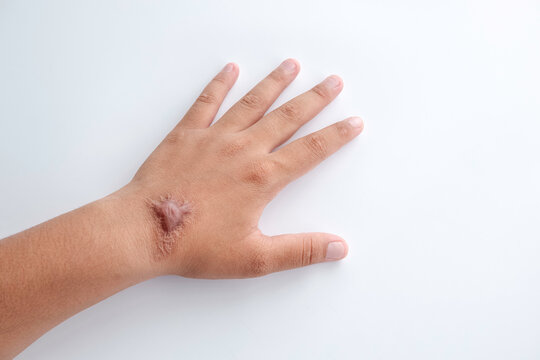 Hypertrophic Keloid scar on hand back of young woman on white background, imperfections skin concept