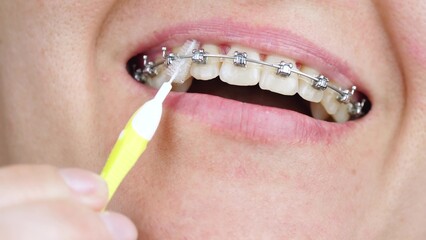 Oral hygiene. Mouth close up, brushing teeth during braces. Dental health, bite correction. orthodontics