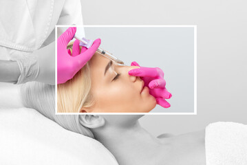 The doctor does injections to correct the hump on the nose with the beauty of the blonde. The...