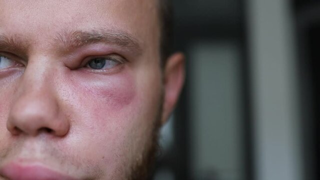 inflammation of the eye conjunctivitis, an allergic reaction in a man