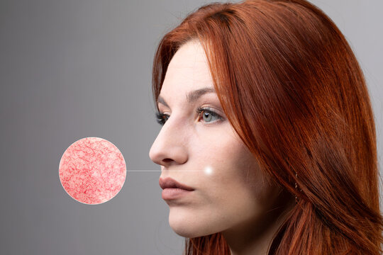 Red haired woman suffering from rosacea. Circle with zoom on the flushed cheek