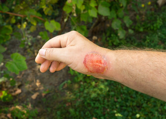 A second degree burn on a man's hand. Large red wound on the arm.