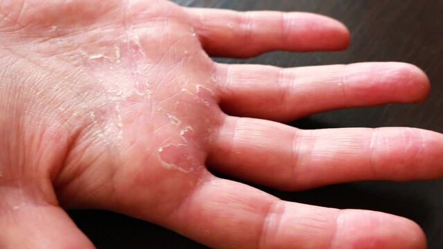A close up of a girl’s hand with damaged skin, showing signs of dryness, cracking and peeling for environmental and dermatological factors