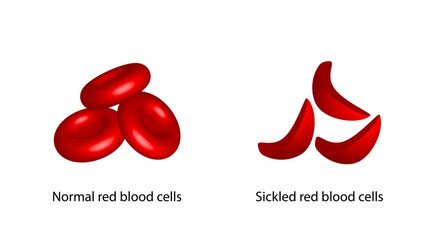 Sickle cell anemia, disease. Normal red blood cell and sickle cell, isolated on white background. Gene mutation. Vector illustration.