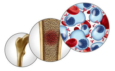 Multiple Myeloma concept and plasma cell cancer as a cancerous growth inside the bone marrow
