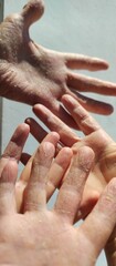 a close-up photo of eczema on hands