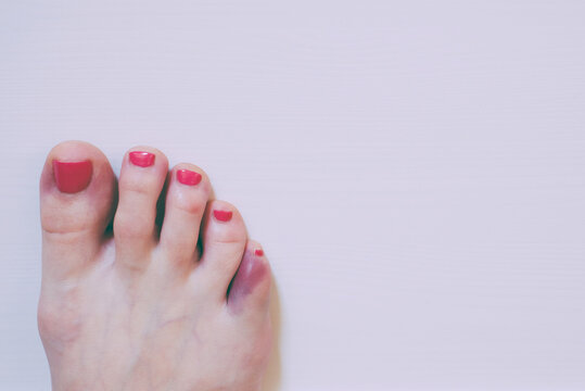 Foot with broken pinky toe caused by forceful impact with furniture. Baby toe fracture and hematoma. Copy space for text.