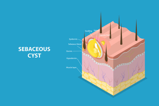 3D Isometric Flat Vector Conceptual Illustration of Sebaceous Cyst