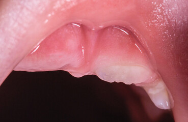 Swelling of the gums during the eruption of permanent teeth after the loss of milk teeth in...