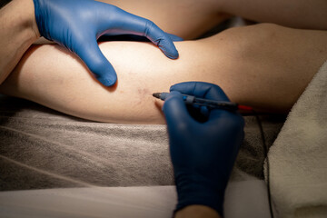 Phlebologist makes injections into a vein, performing sclerotherapy on the veins of women's leg,...